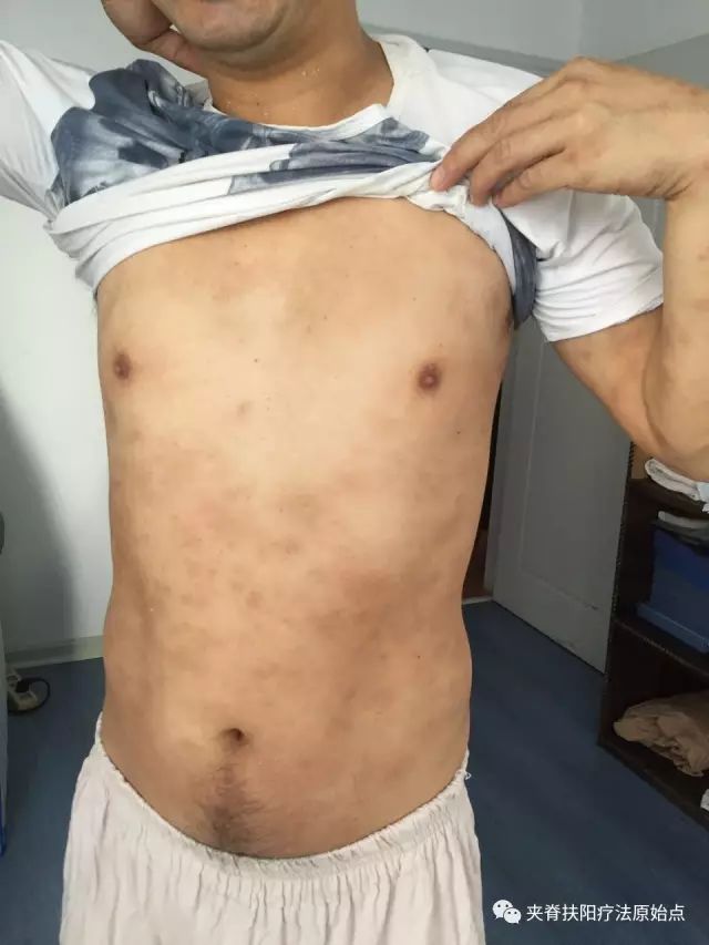 案例分享:原始点调理5年慢性荨麻疹 案例分享:原始点调理5年慢性荨麻疹