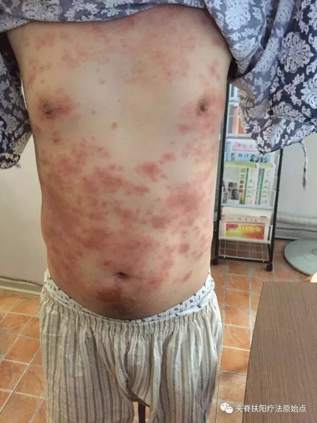案例分享:原始点调理5年慢性荨麻疹 案例分享:原始点调理5年慢性荨麻疹