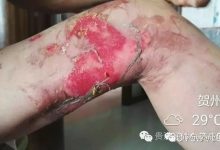 案例分享:原始点调理车祸烧伤不留疤的案例-原始点全球同学网