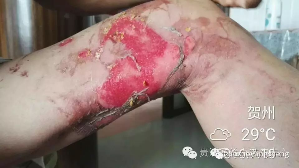 案例分享：原始点调理车祸烧伤不留疤的案例-原始点全球同学网