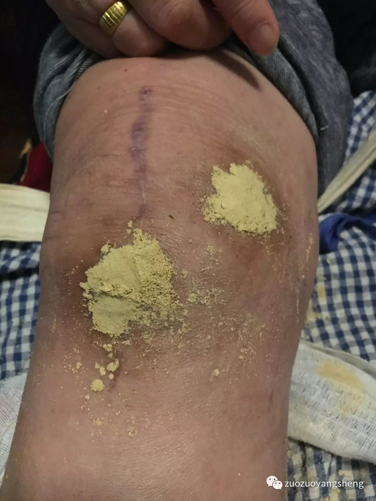 案例分享:最难度的家人——原始点调理妈妈骨折手术后的康复 案例分享:最难度的家人——原始点调理妈妈骨折手术后的康复