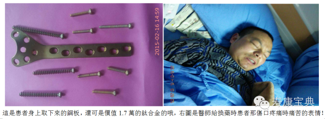 案例分享:原始点调理骨折手术后的恢复 案例分享:原始点调理骨折手术后的恢复