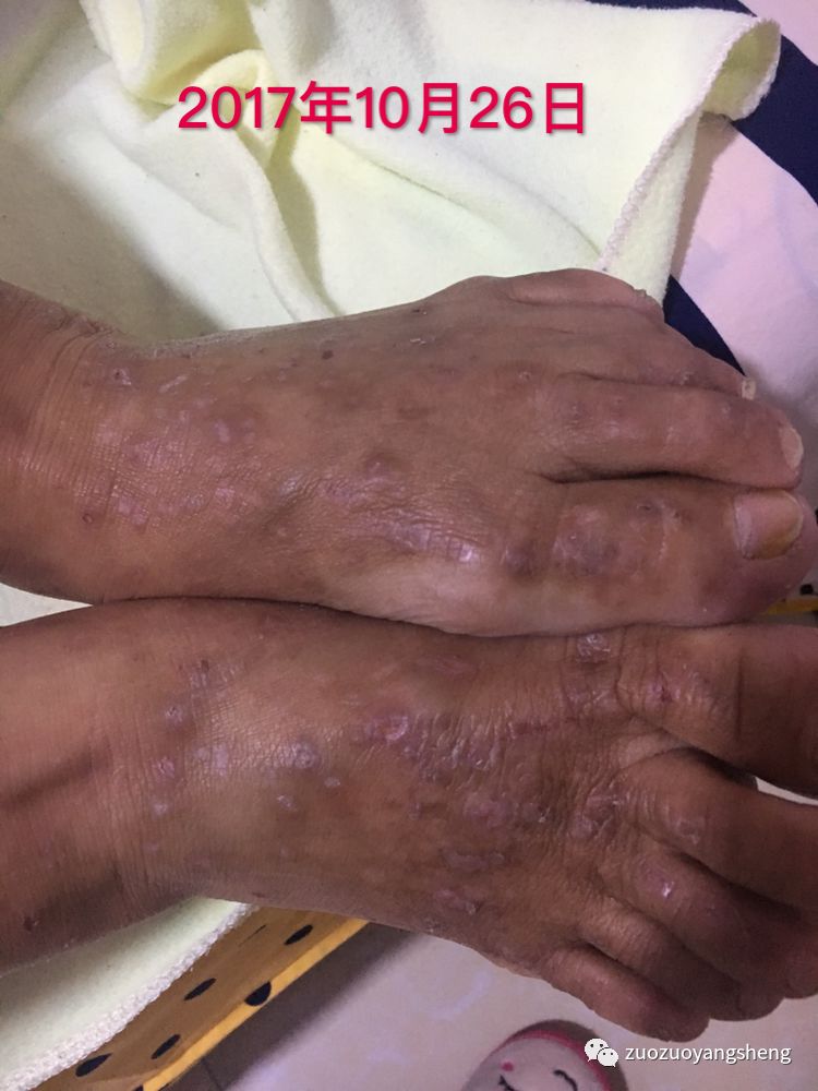 案例分享:原始点调理全身奇痒无比的湿疹案例 案例分享:原始点调理全身奇痒无比的湿疹案例