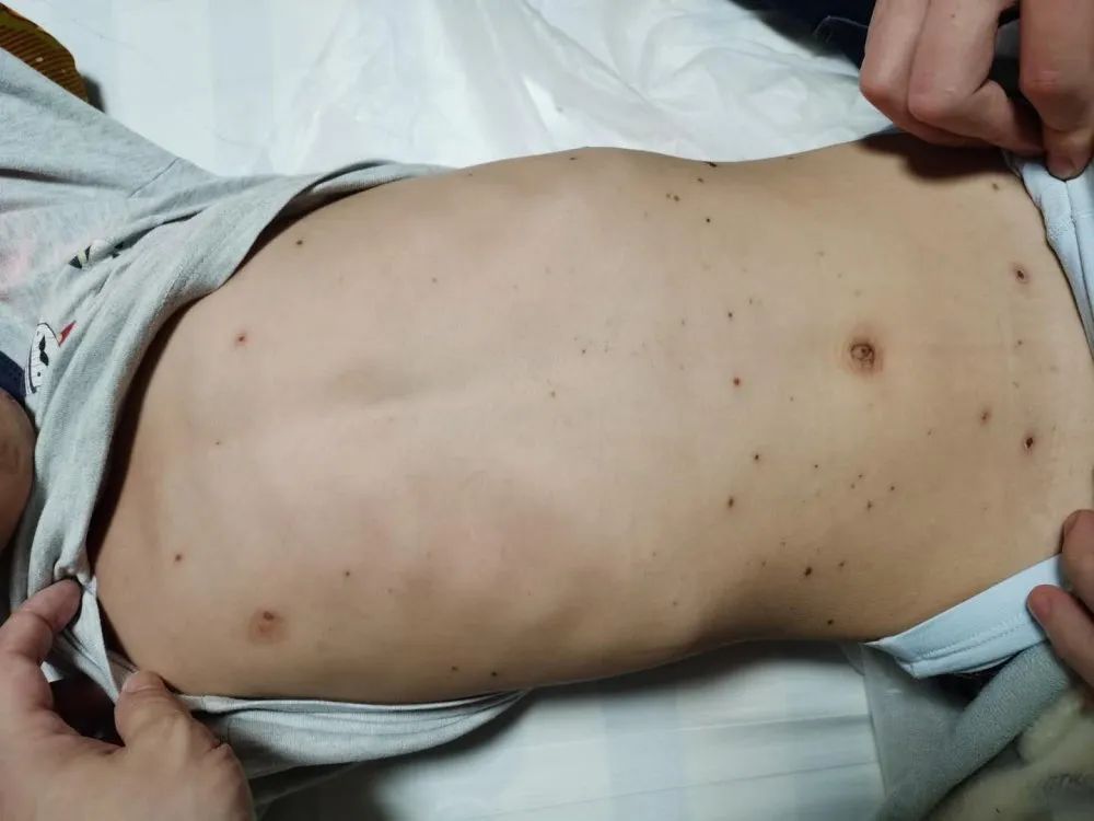 案例分享:原始点调理孩子水痘案例 案例分享:原始点调理孩子水痘案例