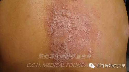 案例分享:原始点调理带状疱疹的案例 案例分享:原始点调理带状疱疹的案例