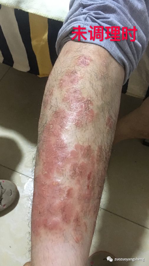 案例分享:原始点调理十几年牛皮癣的案例 案例分享:原始点调理十几年牛皮癣的案例