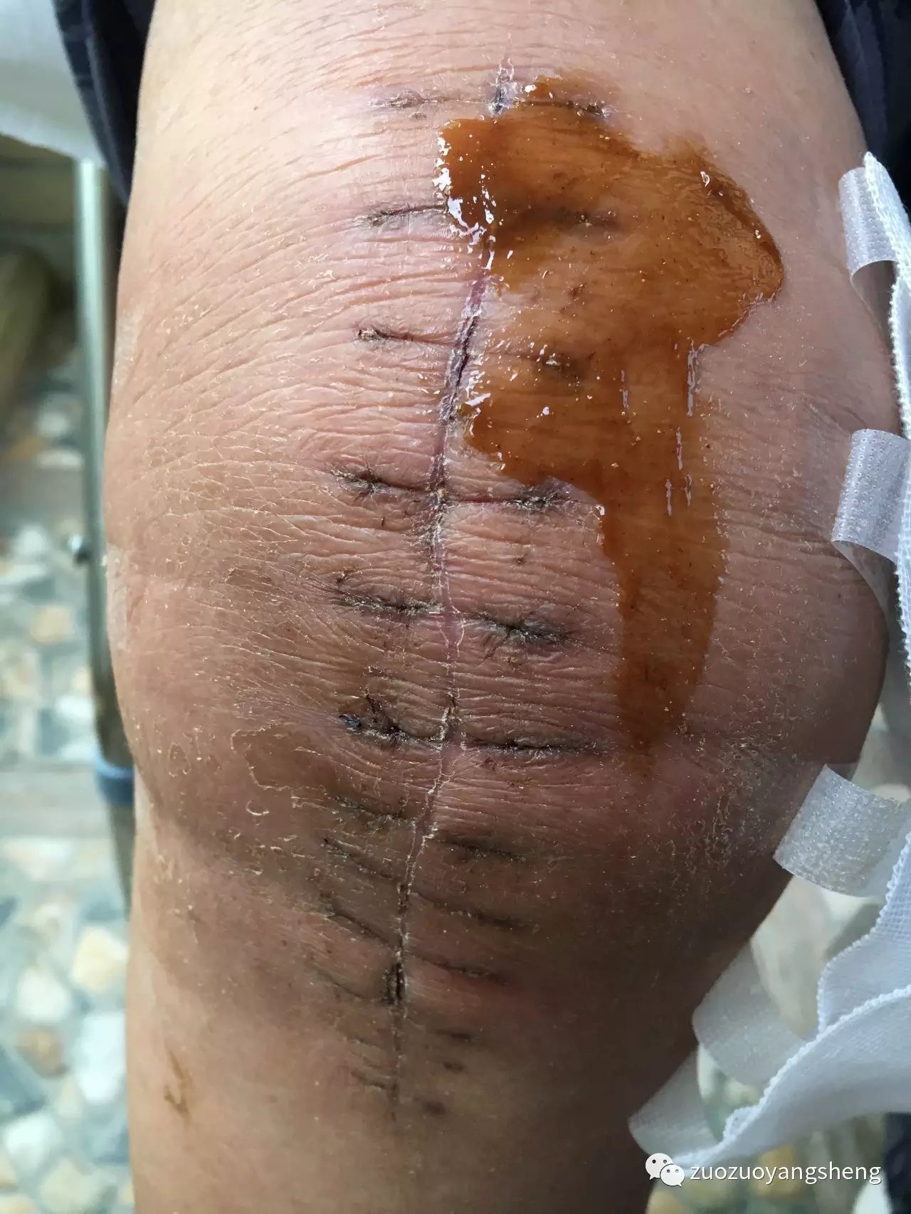 案例分享:最难度的家人——原始点调理妈妈骨折手术后的康复 案例分享:最难度的家人——原始点调理妈妈骨折手术后的康复