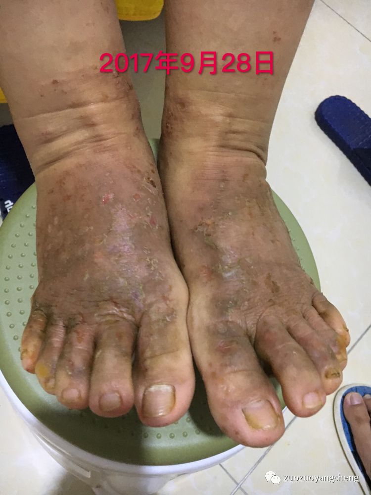 案例分享:原始点调理全身奇痒无比的湿疹案例 案例分享:原始点调理全身奇痒无比的湿疹案例