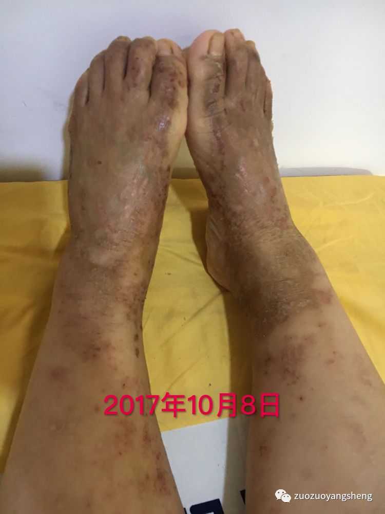 案例分享:原始点调理全身奇痒无比的湿疹案例 案例分享:原始点调理全身奇痒无比的湿疹案例