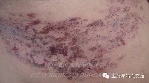 案例分享:原始点调理带状疱疹的案例 案例分享:原始点调理带状疱疹的案例
