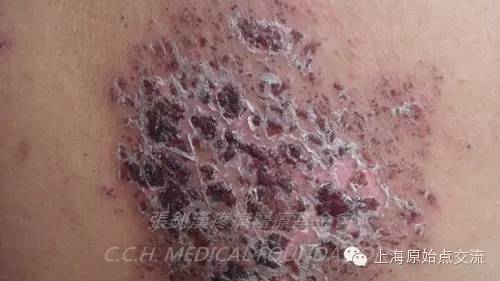 案例分享:原始点调理带状疱疹的案例 案例分享:原始点调理带状疱疹的案例