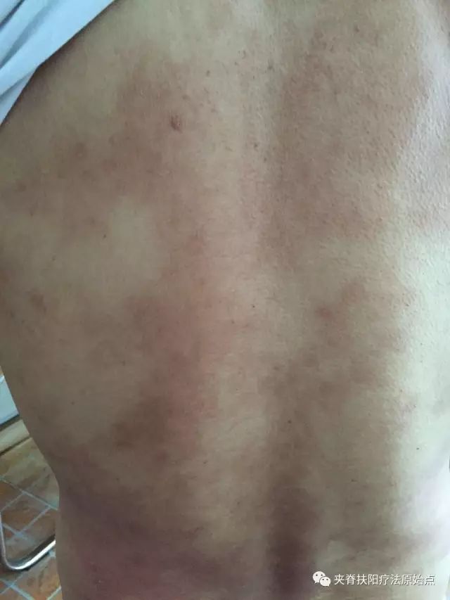 案例分享:原始点调理5年慢性荨麻疹 案例分享:原始点调理5年慢性荨麻疹