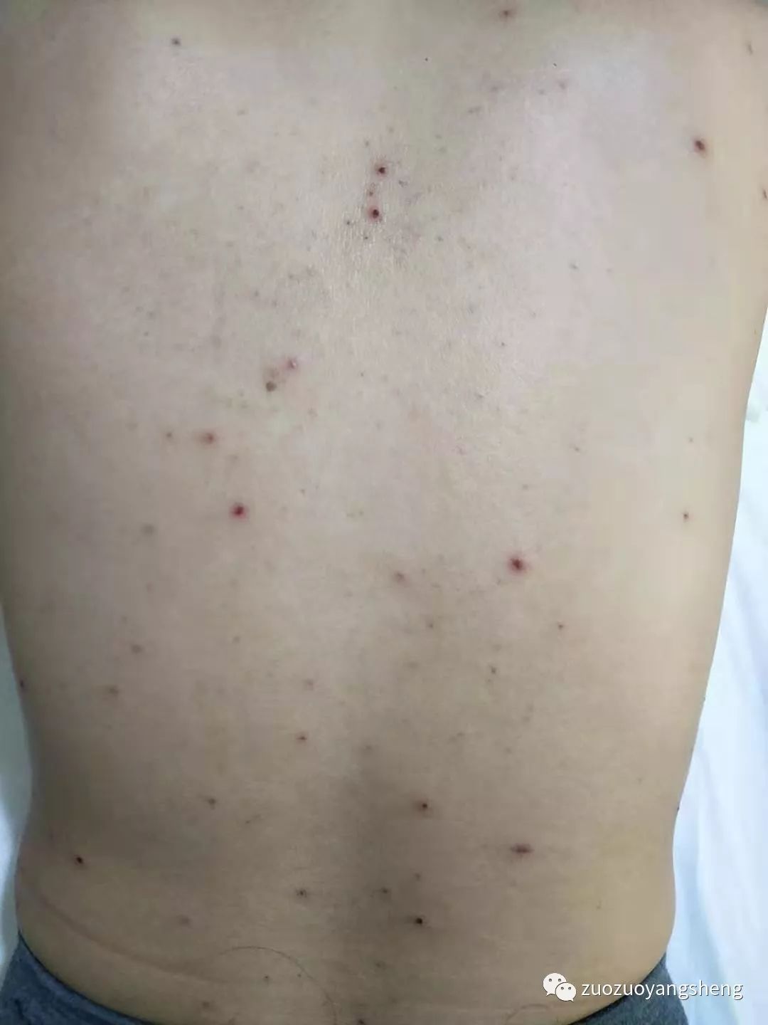 案例分享:原始点调理成人水痘案例 案例分享:原始点调理成人水痘案例