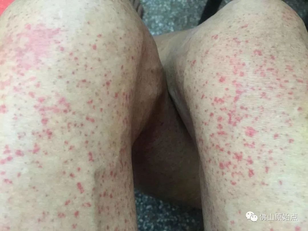 原始点调理肺肿瘤案例 原始点调理肺肿瘤案例