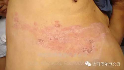 案例分享:原始点调理带状疱疹的案例 案例分享:原始点调理带状疱疹的案例