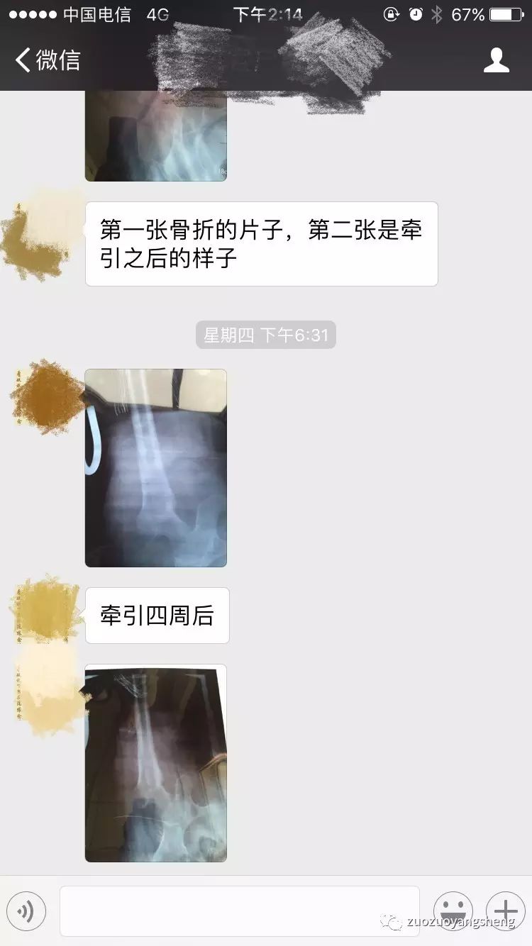 原始点续写又一奇迹:83岁婆婆骨折错位没开刀没手术,6周康复 原始点续写又一奇迹:83岁婆婆骨折错位没开刀没手术,6周康复