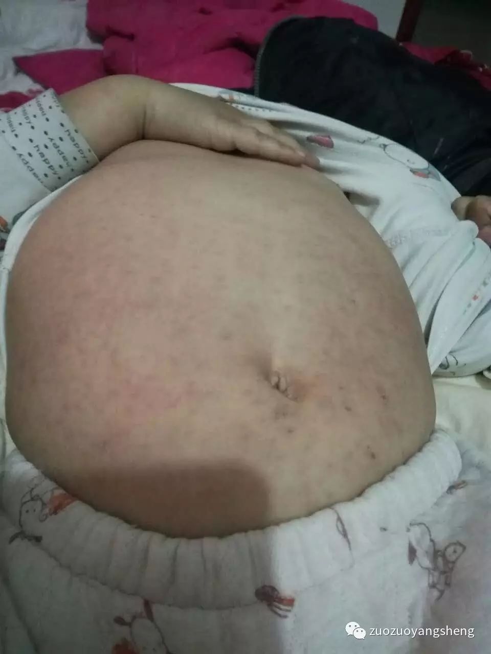 案例分享:原始点调理小朋友的婴幼儿急疹案例 案例分享:原始点调理小朋友的婴幼儿急疹案例