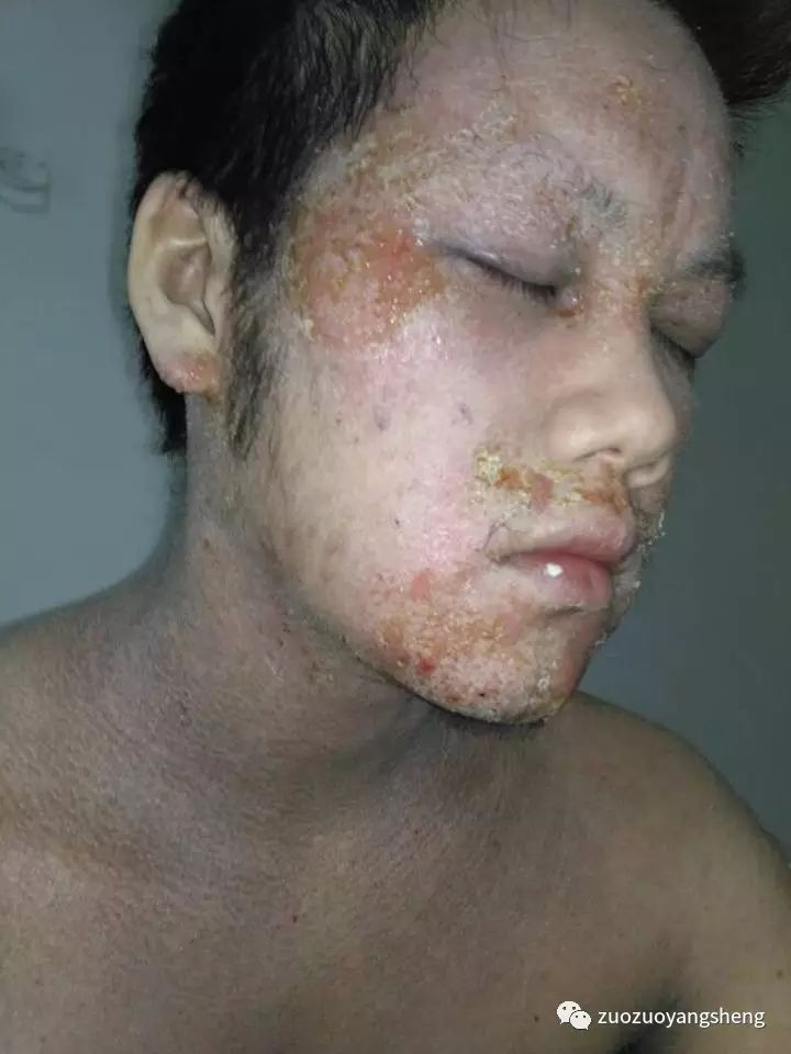 案例分享:马来西亚男孩严重湿疹,10天大变样 案例分享:马来西亚男孩严重湿疹,10天大变样