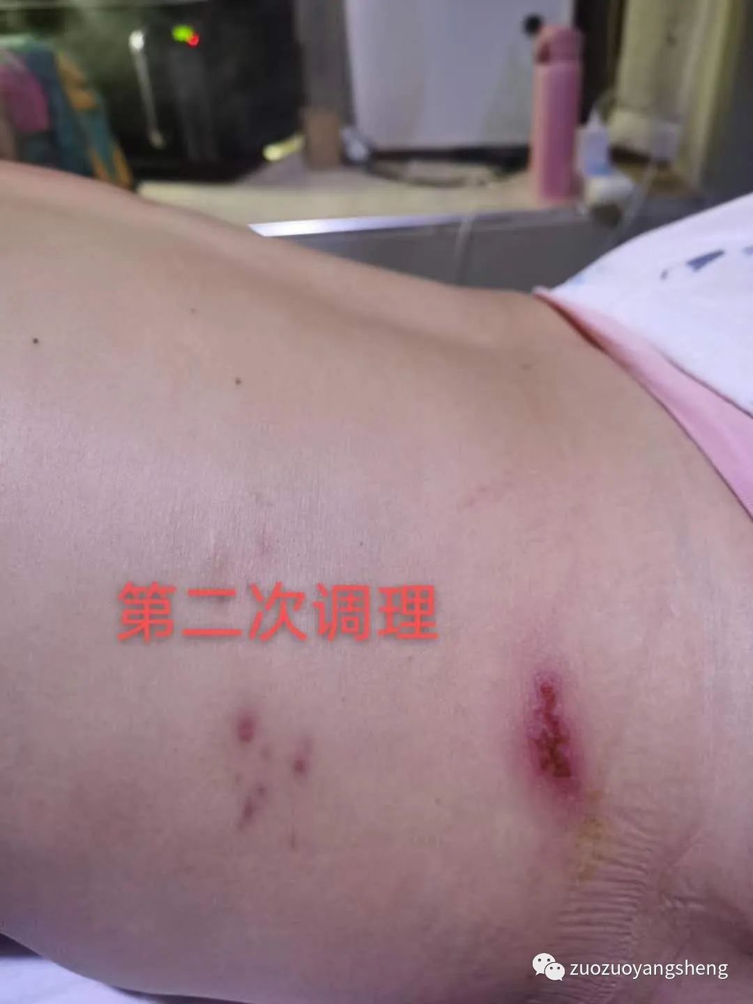 案例分享:原始点调理带状疱疹两次后结痂脱落案例 案例分享:原始点调理带状疱疹两次后结痂脱落案例