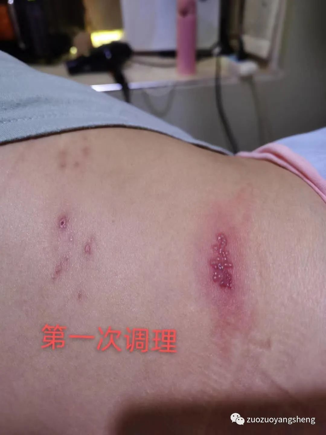 案例分享:原始点调理带状疱疹两次后结痂脱落案例 案例分享:原始点调理带状疱疹两次后结痂脱落案例