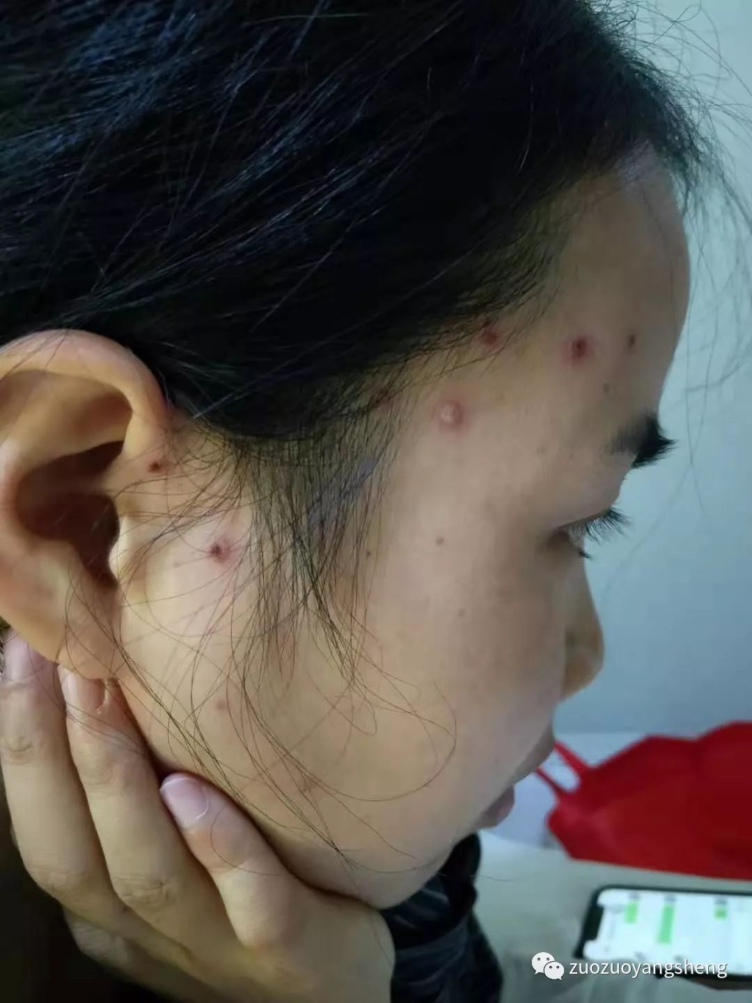 案例分享:原始点调理成人水痘案例 案例分享:原始点调理成人水痘案例