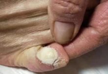 微问答159期：“鸡眼”用原始点怎么调理？-原始点全球同学网