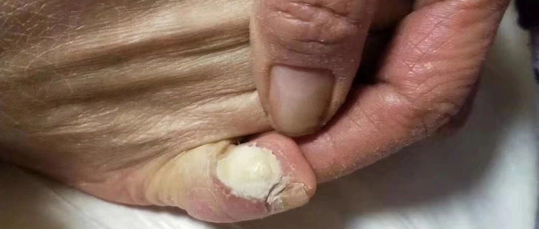 微问答159期：“鸡眼”用原始点怎么调理？-原始点全球同学网