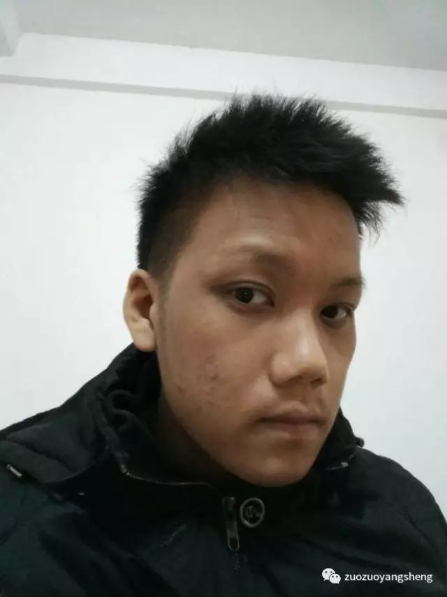 案例分享:马来西亚男孩严重湿疹,10天大变样 案例分享:马来西亚男孩严重湿疹,10天大变样