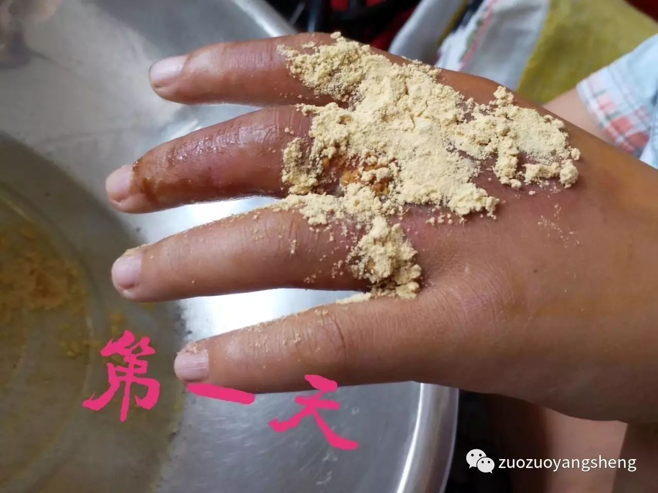 案例分享：原始点调理小朋友手部烫伤的案例