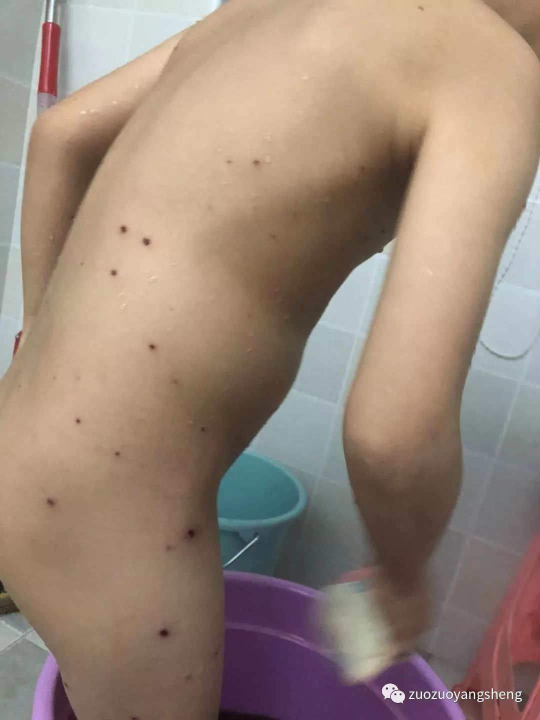 案例分享:原始点调理五岁小孩长水痘案例 案例分享:原始点调理五岁小孩长水痘案例