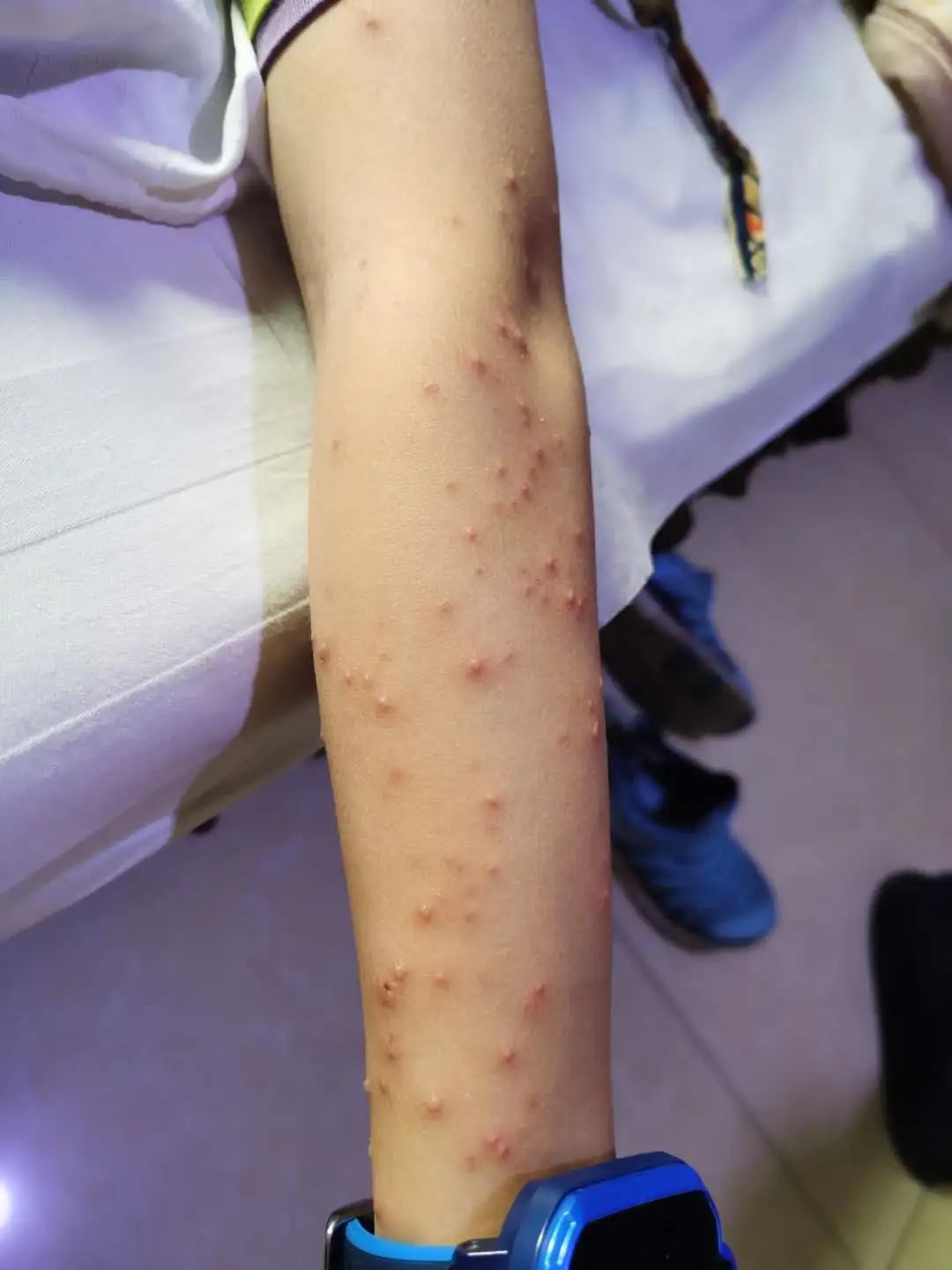 案例分享:原始点调理孩子水痘案例 案例分享:原始点调理孩子水痘案例