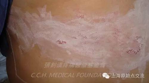 案例分享:原始点调理带状疱疹的案例 案例分享:原始点调理带状疱疹的案例