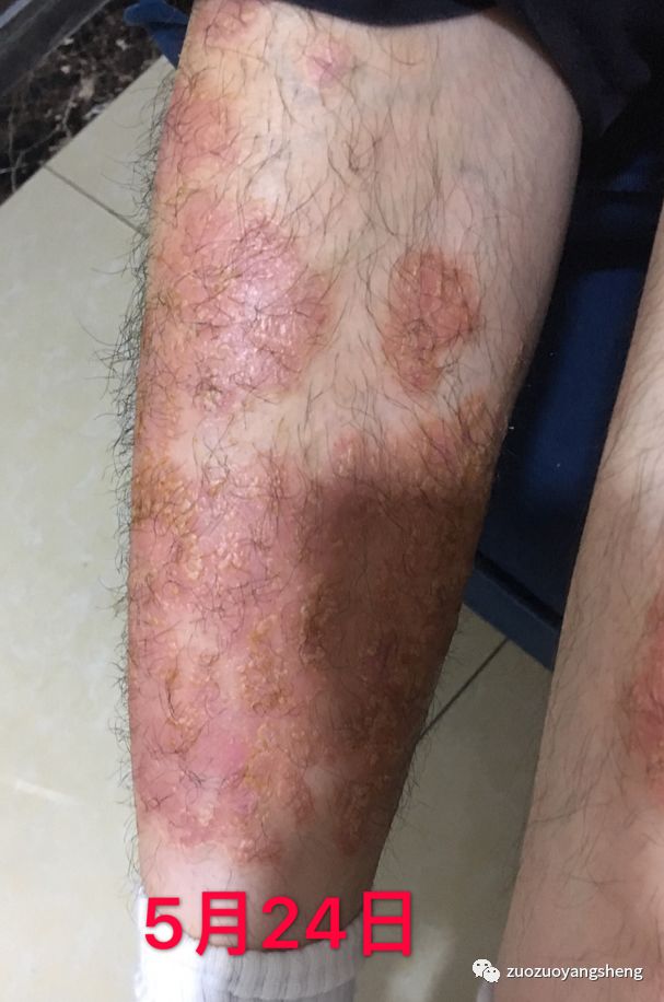 案例分享:原始点调理十几年牛皮癣的案例 案例分享:原始点调理十几年牛皮癣的案例