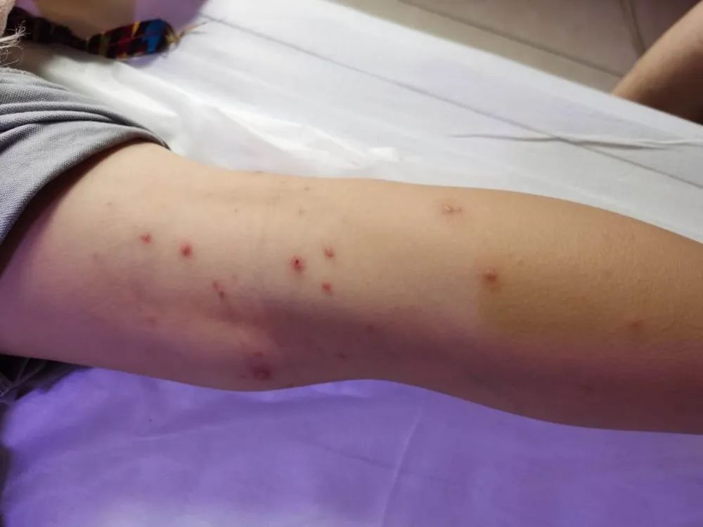 案例分享:原始点调理孩子水痘案例 案例分享:原始点调理孩子水痘案例