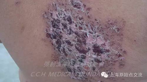 案例分享:原始点调理带状疱疹的案例 案例分享:原始点调理带状疱疹的案例