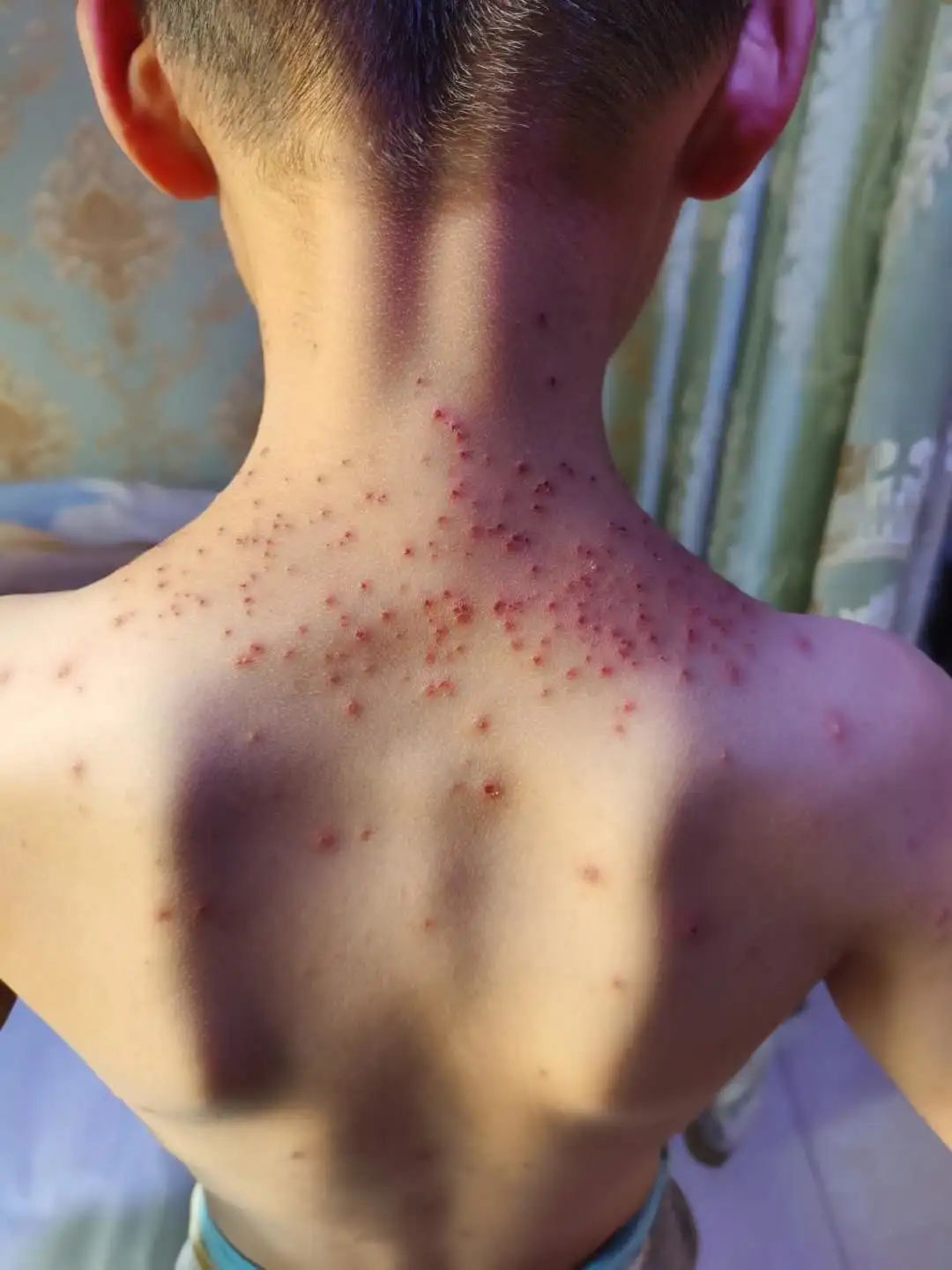 案例分享:原始点调理孩子水痘案例 案例分享:原始点调理孩子水痘案例