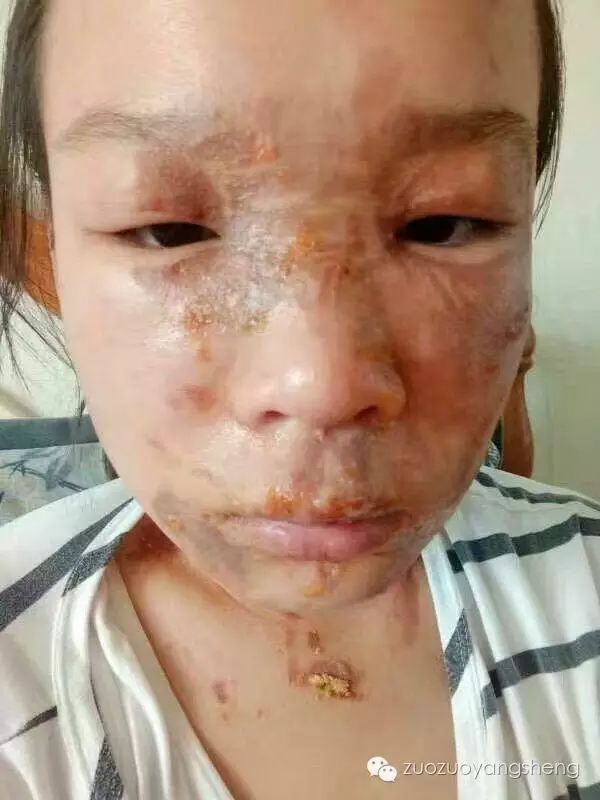 案例分享:原始点调理花季少女面部烫伤不留疤的案例 案例分享:原始点调理花季少女面部烫伤不留疤的案例