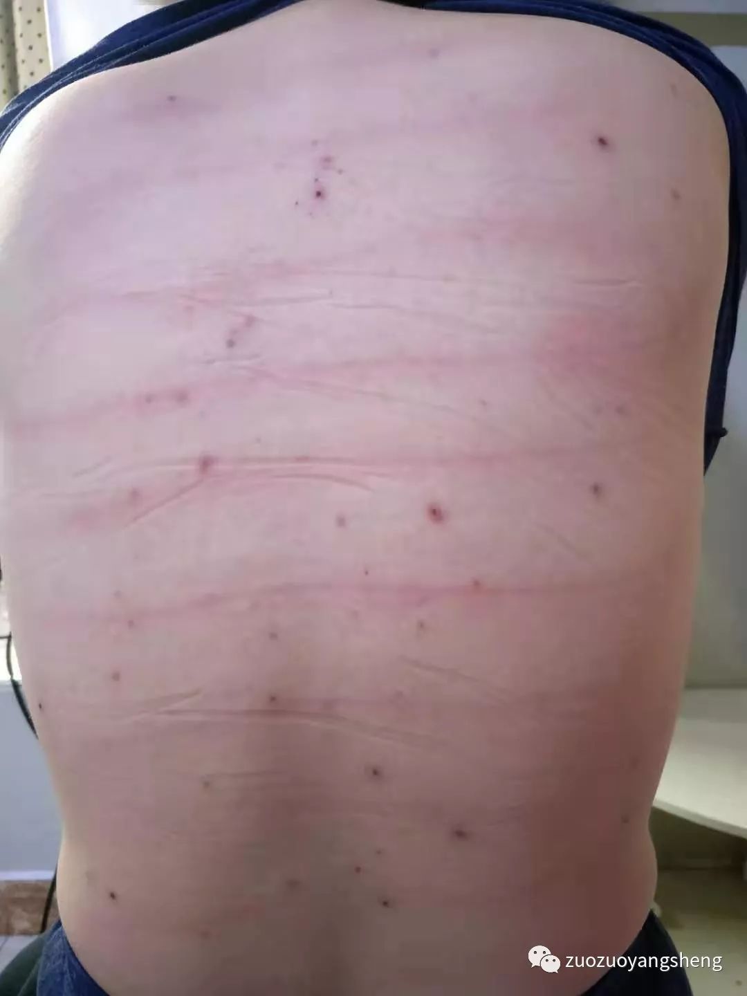 案例分享:原始点调理成人水痘案例 案例分享:原始点调理成人水痘案例