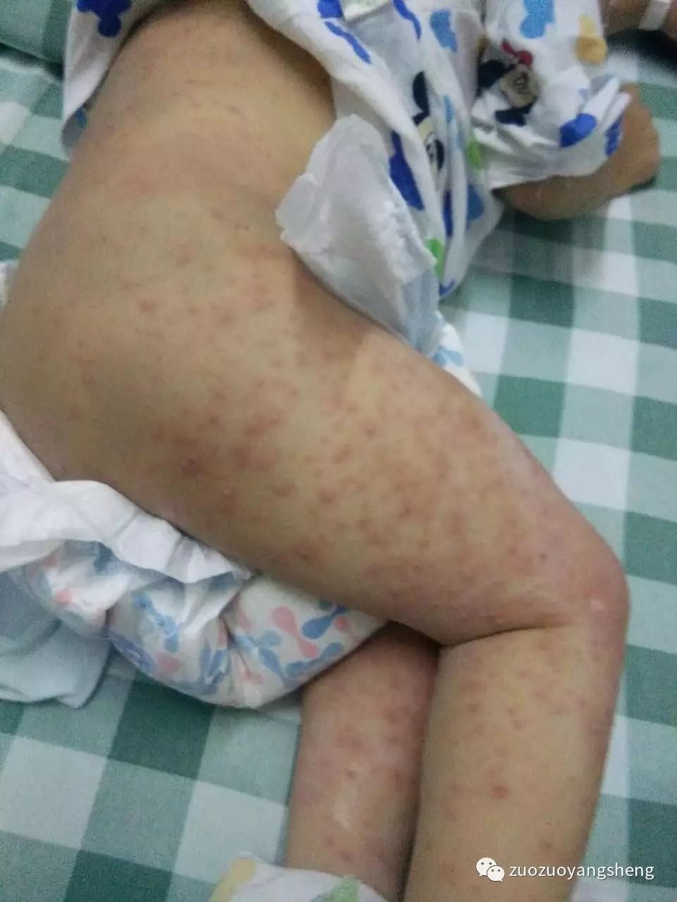 原始点调理幼儿咳嗽后出现严重好转反应