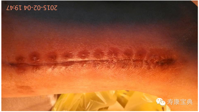 案例分享:原始点调理骨折手术后的恢复 案例分享:原始点调理骨折手术后的恢复