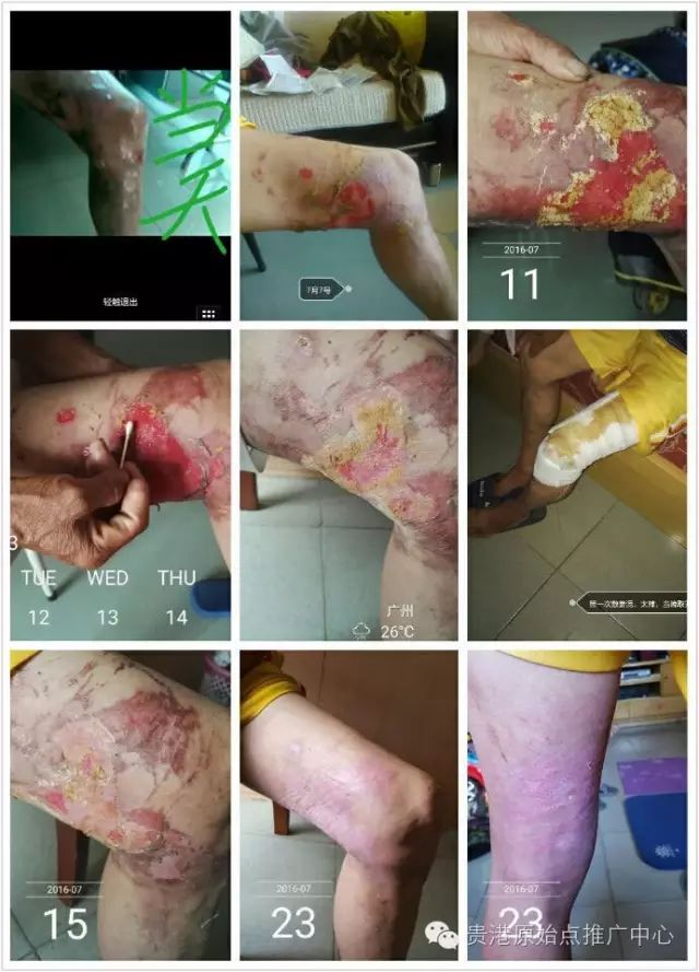 案例分享:原始点调理车祸烧伤不留疤的案例 案例分享:原始点调理车祸烧伤不留疤的案例