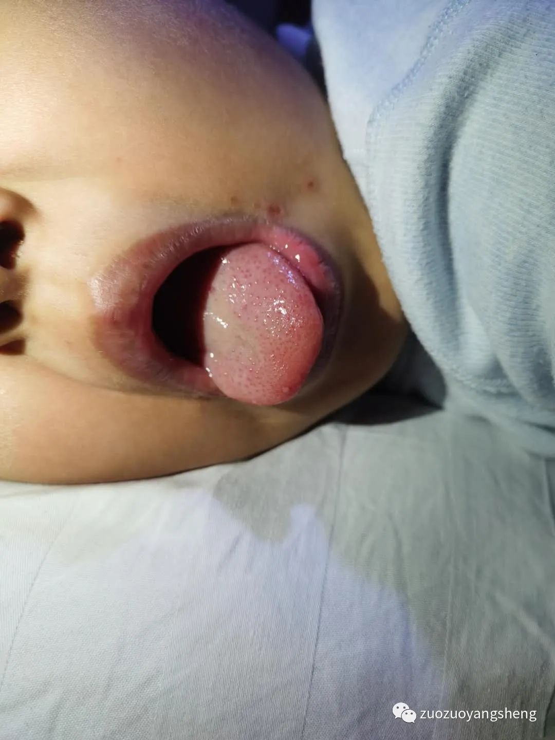 案例分享:原始点调理儿童手足口病的案例 案例分享:原始点调理儿童手足口病的案例