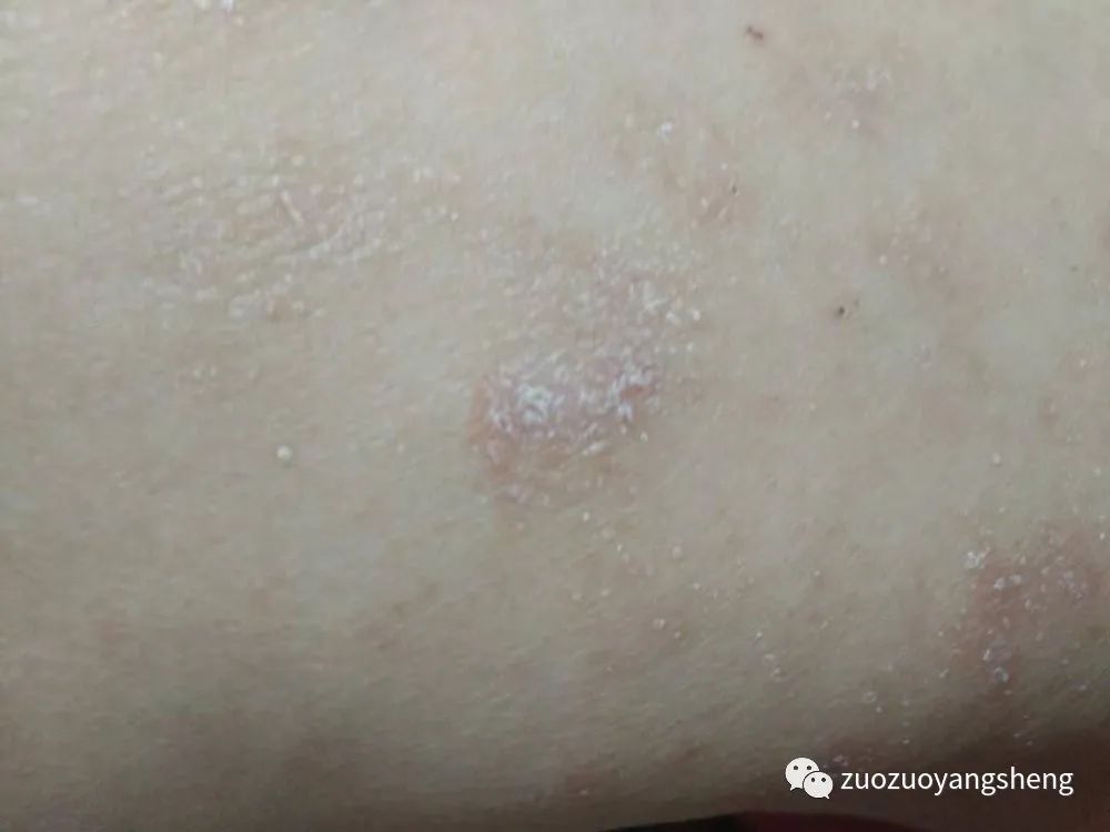 微问答207期:植物人状态,具体按推哪些原始点?如何使用热源? 微问答207期:植物人状态,具体按推哪些原始点?如何使用热源?