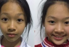 案例分享：原始点调理儿童全身痒的案例-原始点全球同学网