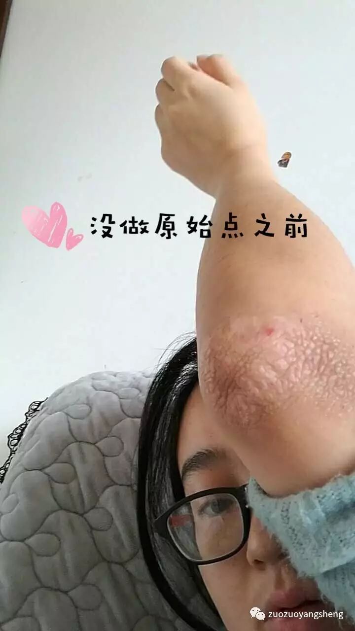 案例分享：原始点调理8年手肘湿疹案例-原始点全球同学网