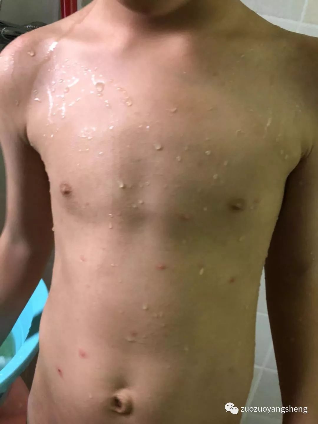 案例分享:原始点调理五岁小孩长水痘案例 案例分享:原始点调理五岁小孩长水痘案例