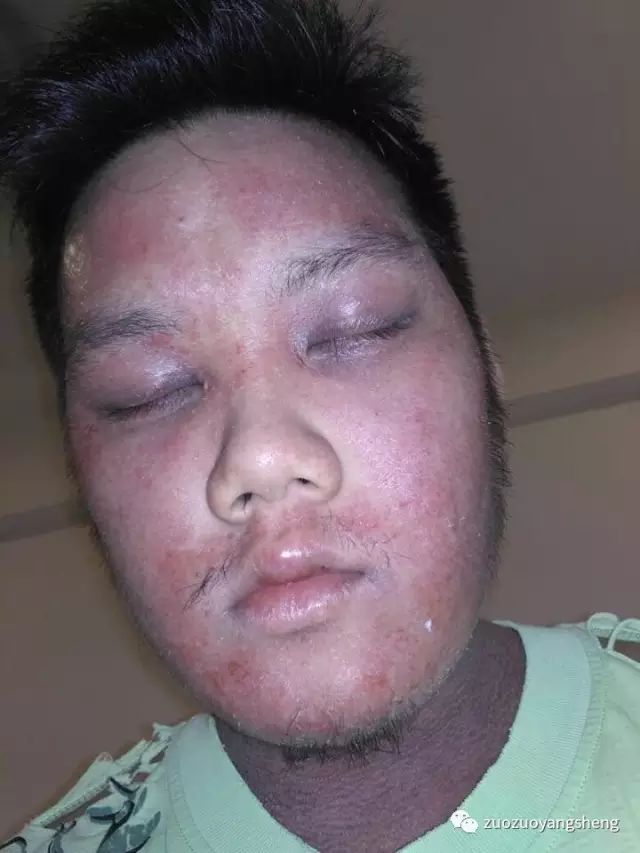 案例分享:马来西亚男孩严重湿疹,10天大变样 案例分享:马来西亚男孩严重湿疹,10天大变样