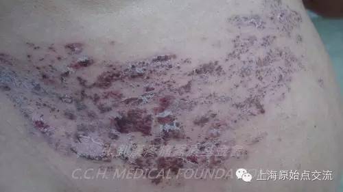 案例分享:原始点调理带状疱疹的案例 案例分享:原始点调理带状疱疹的案例