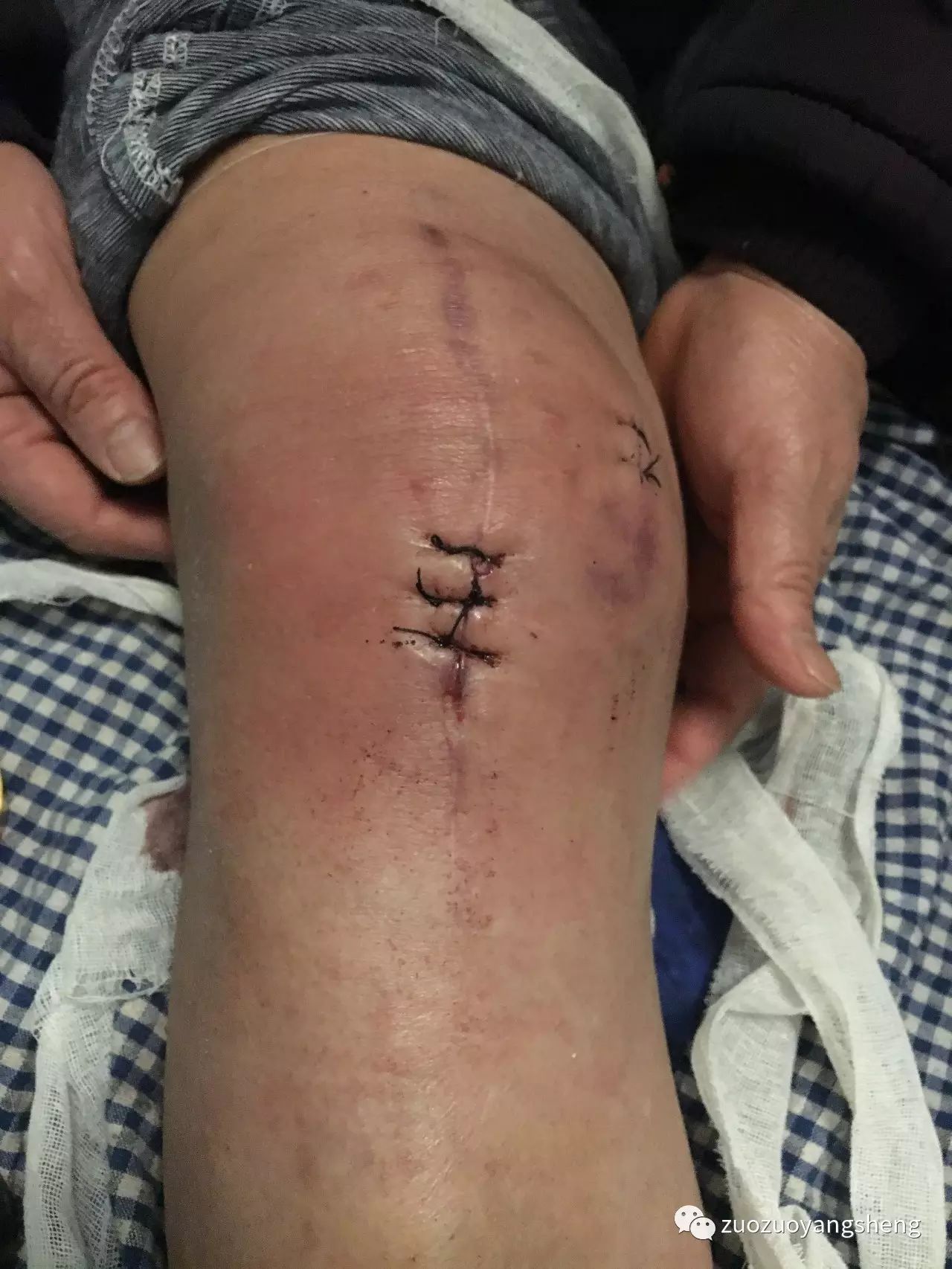 案例分享:最难度的家人——原始点调理妈妈骨折手术后的康复 案例分享:最难度的家人——原始点调理妈妈骨折手术后的康复