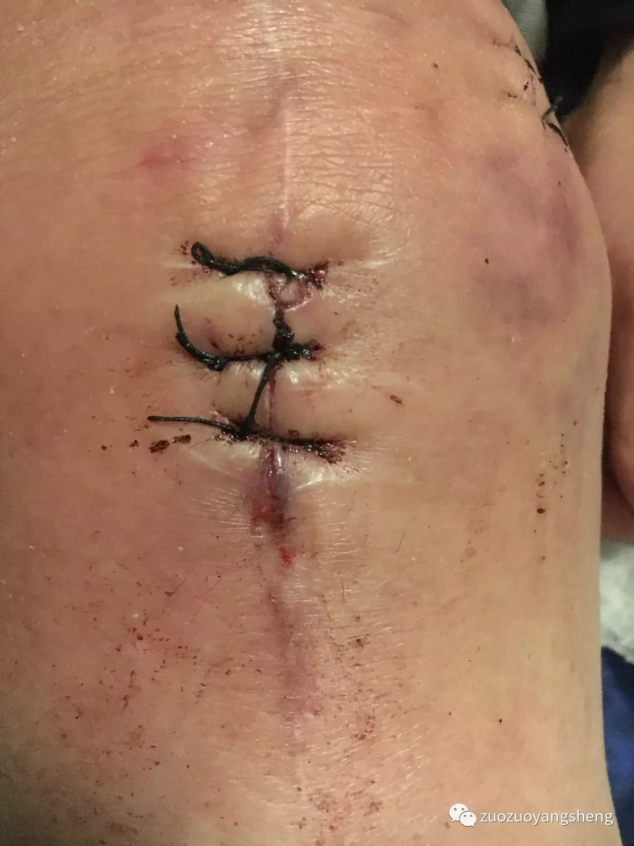 案例分享:最难度的家人——原始点调理妈妈骨折手术后的康复 案例分享:最难度的家人——原始点调理妈妈骨折手术后的康复